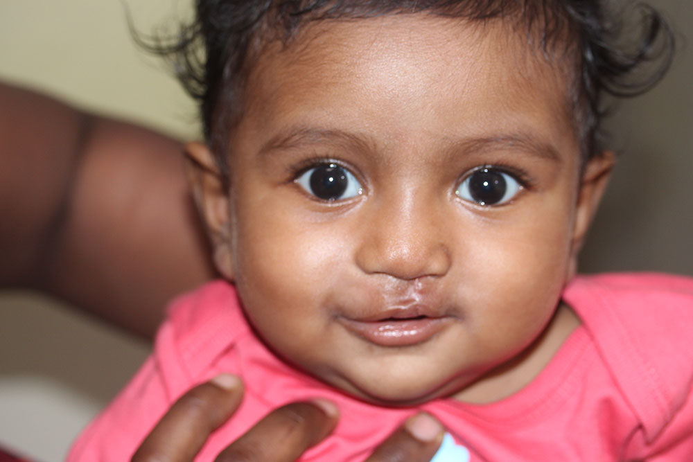 Jaya after her cleft surgery