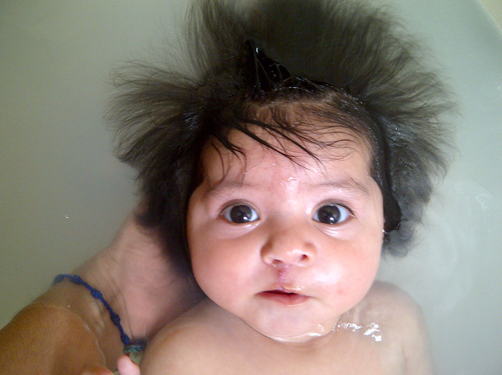 barbara in the bath after cleft surgery