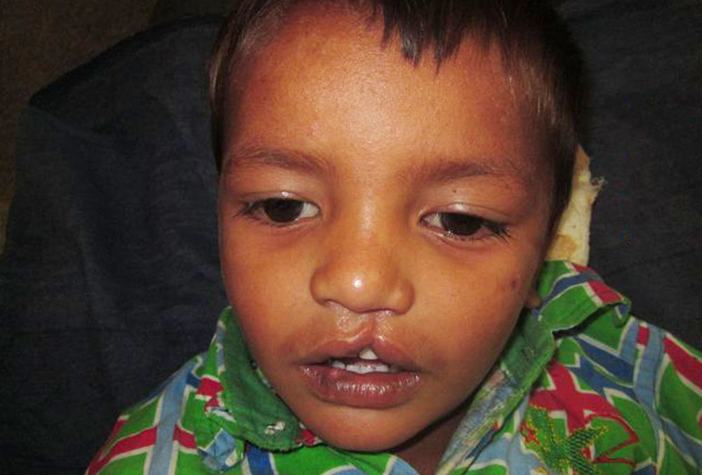 Rajesh before cleft lip surgery