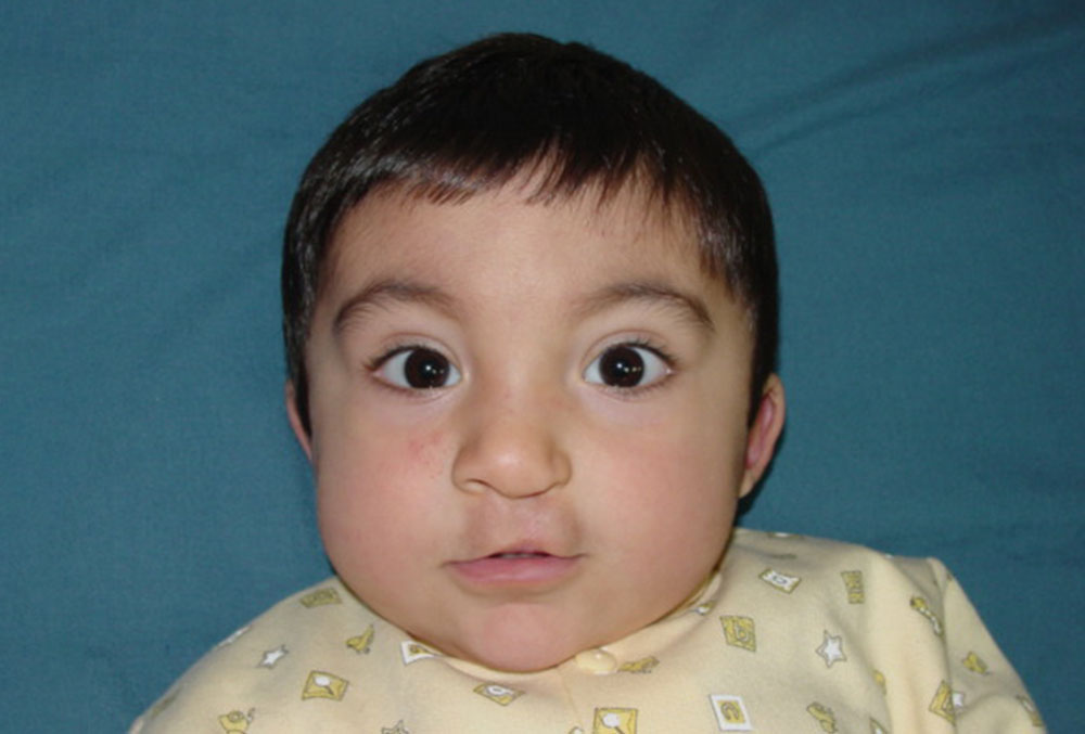 Vicente after cleft surgery