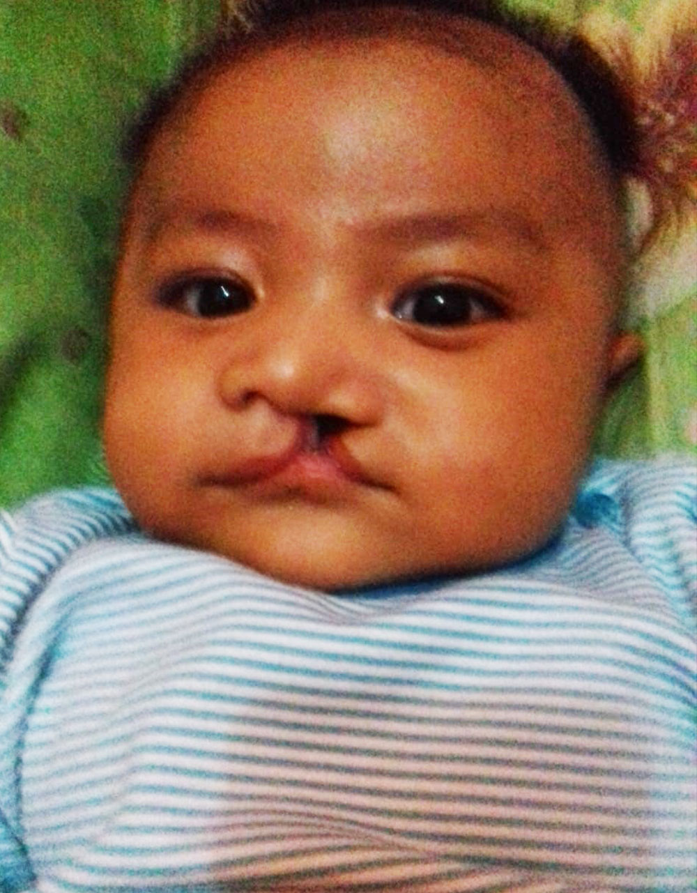 Biru before cleft surgery