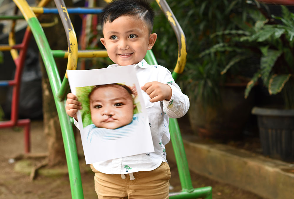 Biru today, holding a picture of himself before cleft surgery