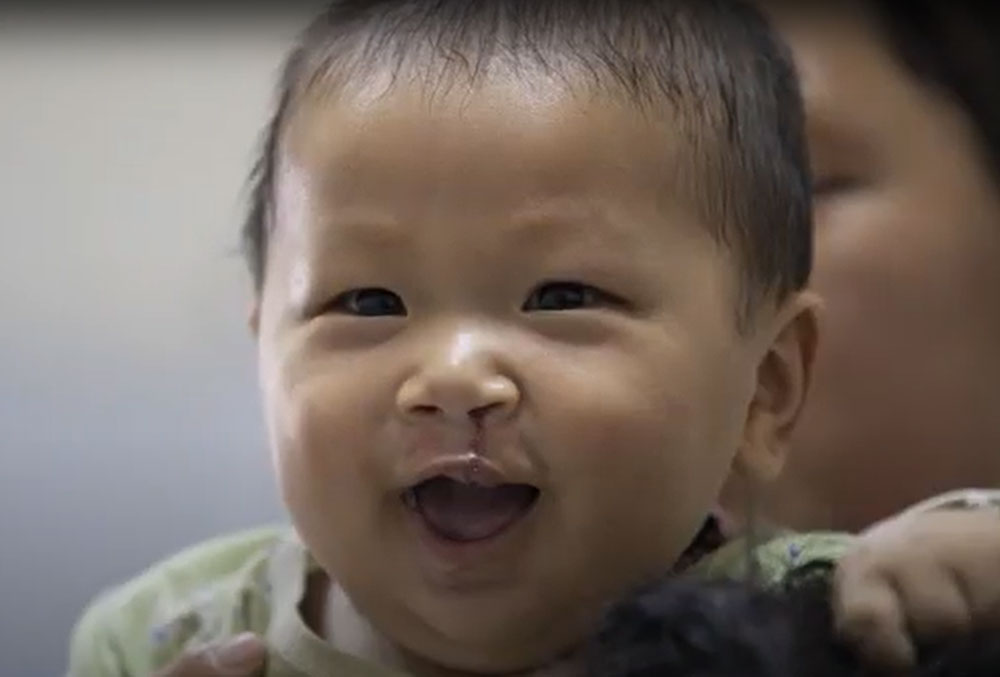 Smile Train patient Jingtee from Cambodia smiles after his cleft surgery