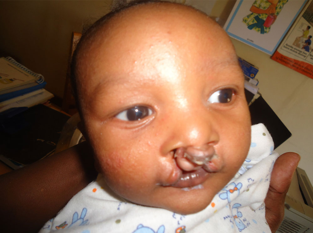 Eric before cleft surgery
