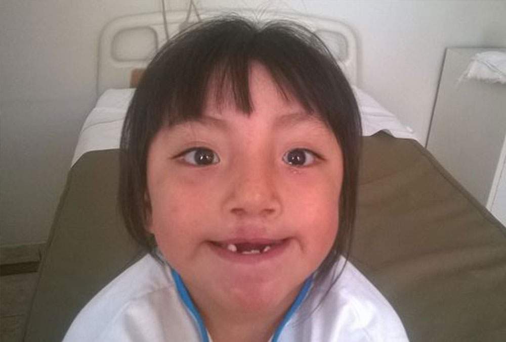Chiara after her second cleft surgery
