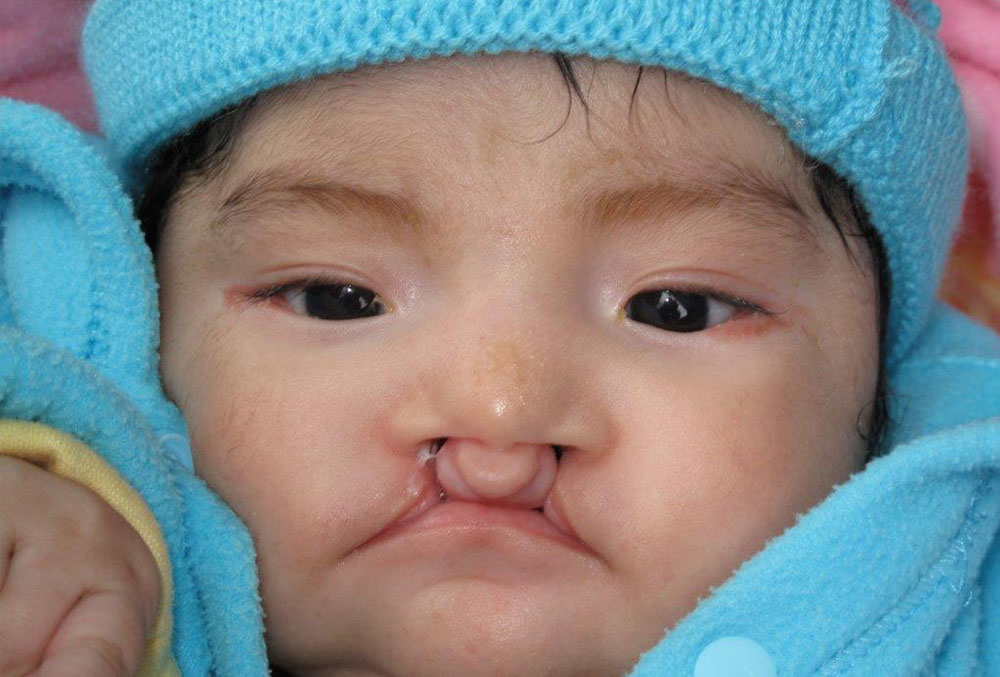 Chiara before cleft surgery