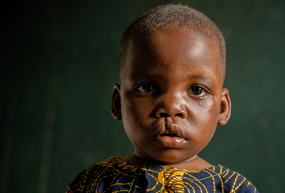 Opeyemi before cleft surgery