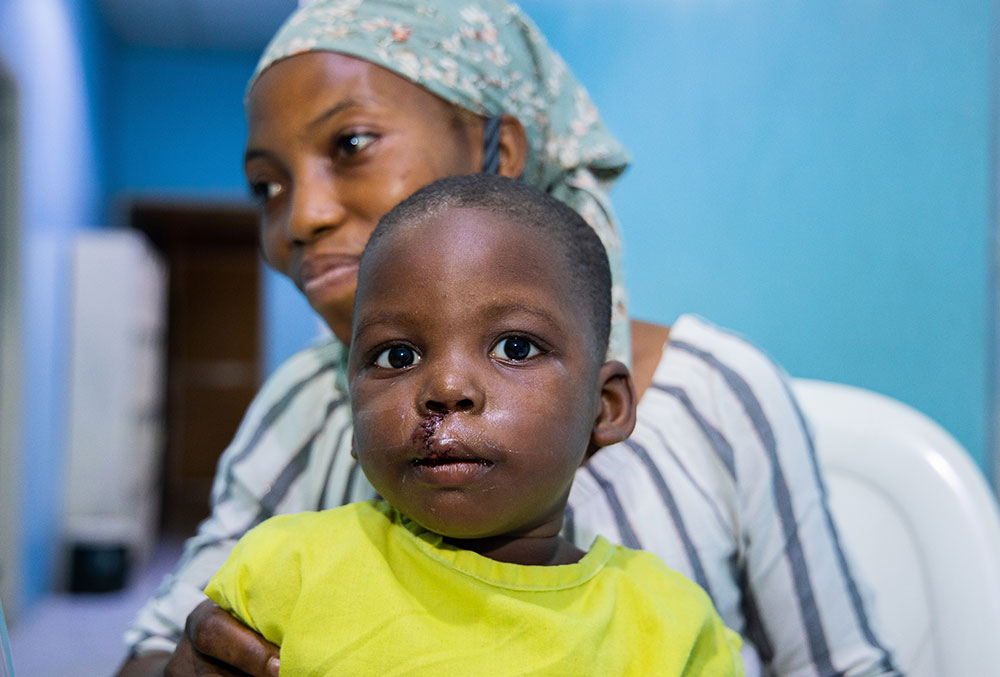 Opeyemi immediately after cleft surgery