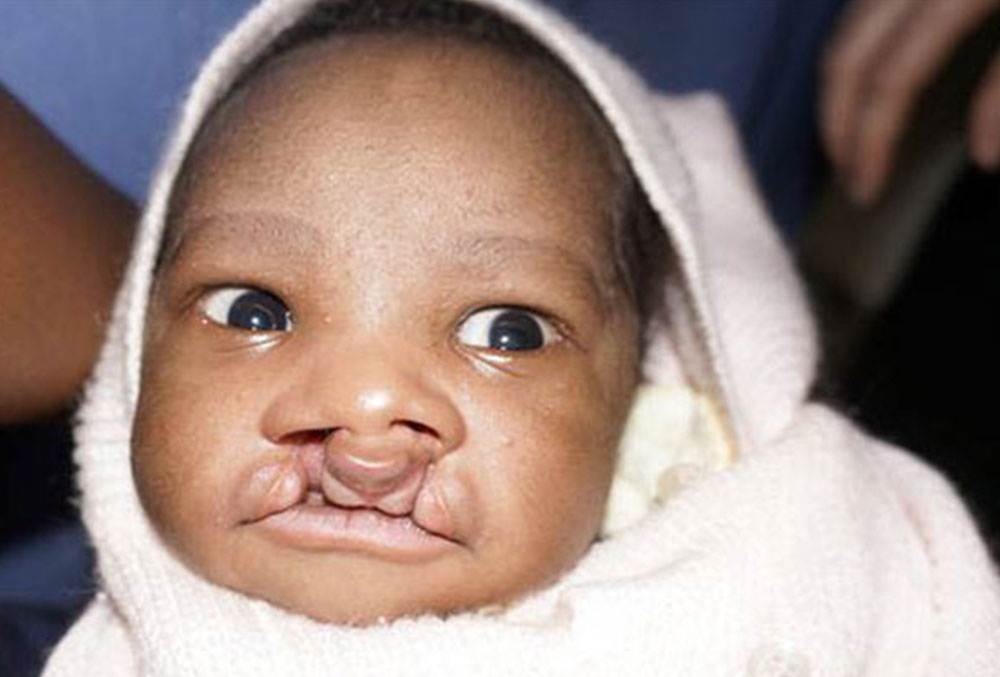 Livingstone before cleft surgery