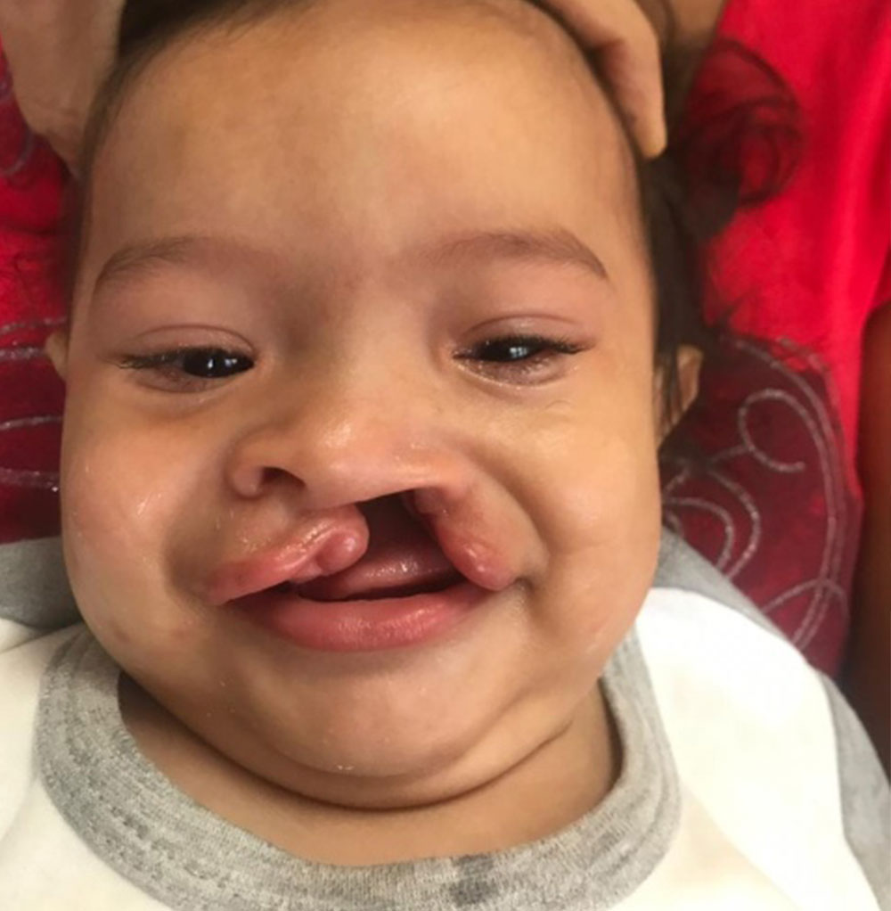 Marco before cleft surgery