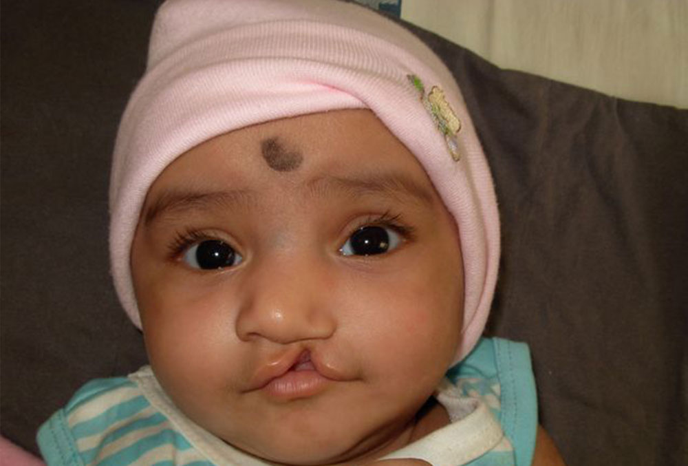 Bhargavi before cleft surgery