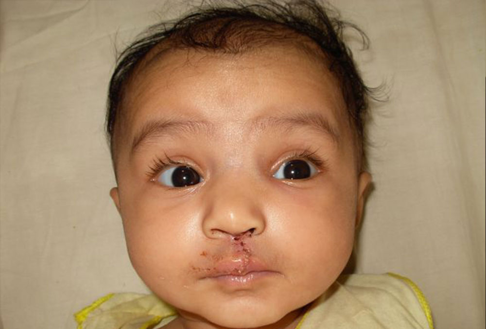 Bhargavi just after cleft surgery