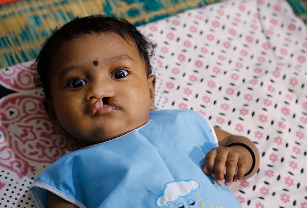Jaya before her first cleft surgery