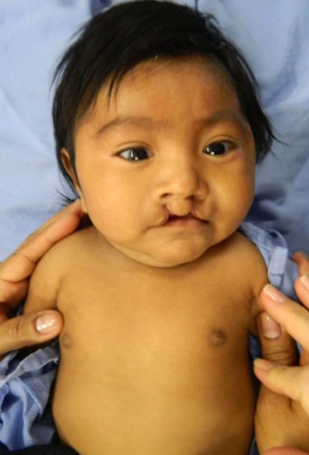 Mathias just before his first cleft surgery