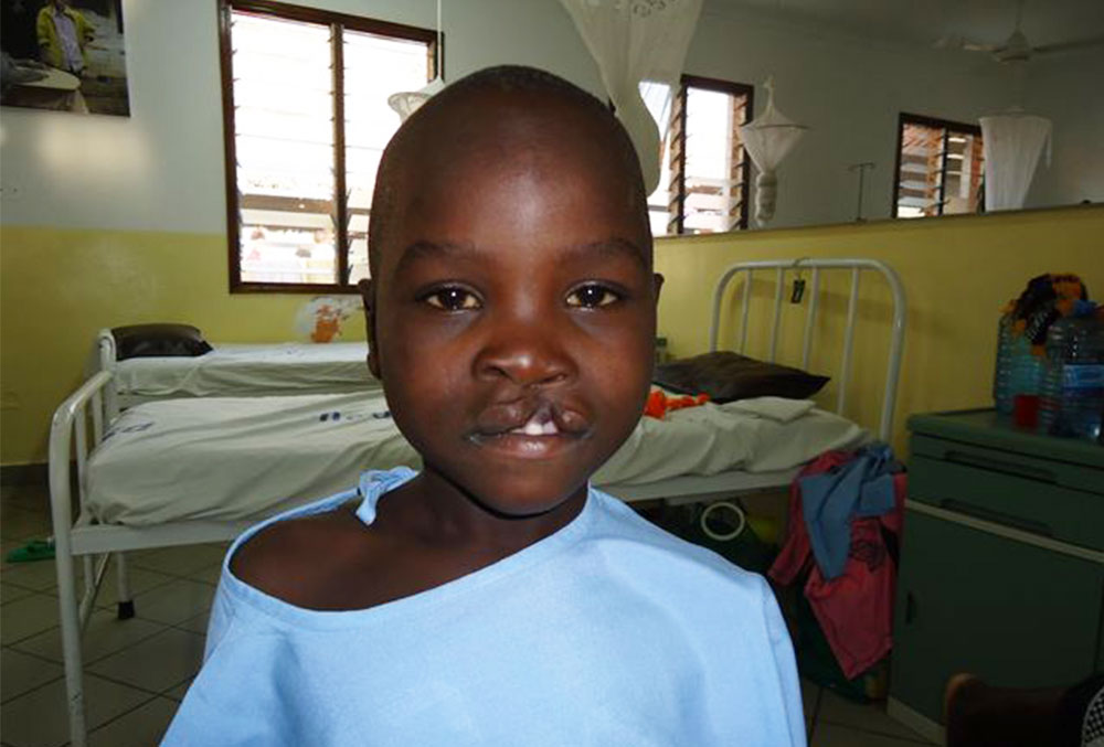 Osawa before cleft surgery