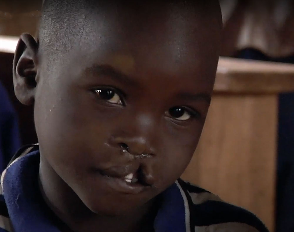 Osawa in school before cleft surgery