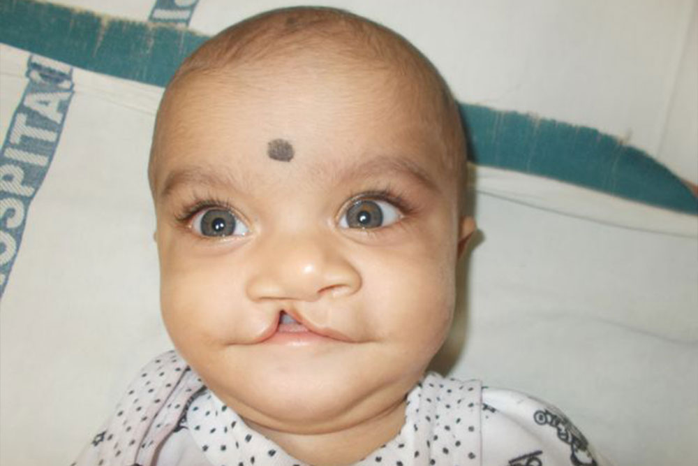 Samrat before cleft surgery