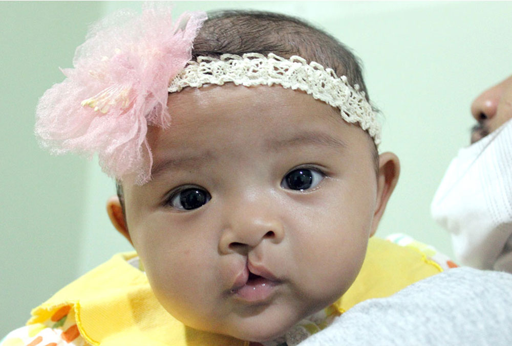 Divya before cleft surgery