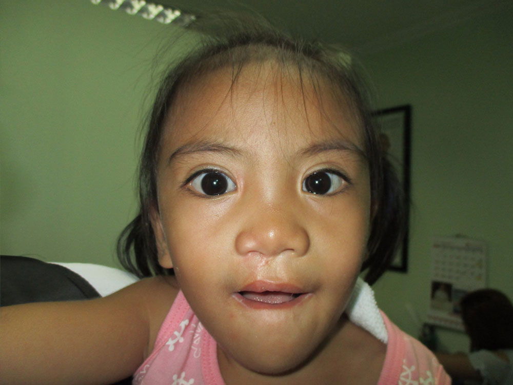 angel after cleft palate surgery