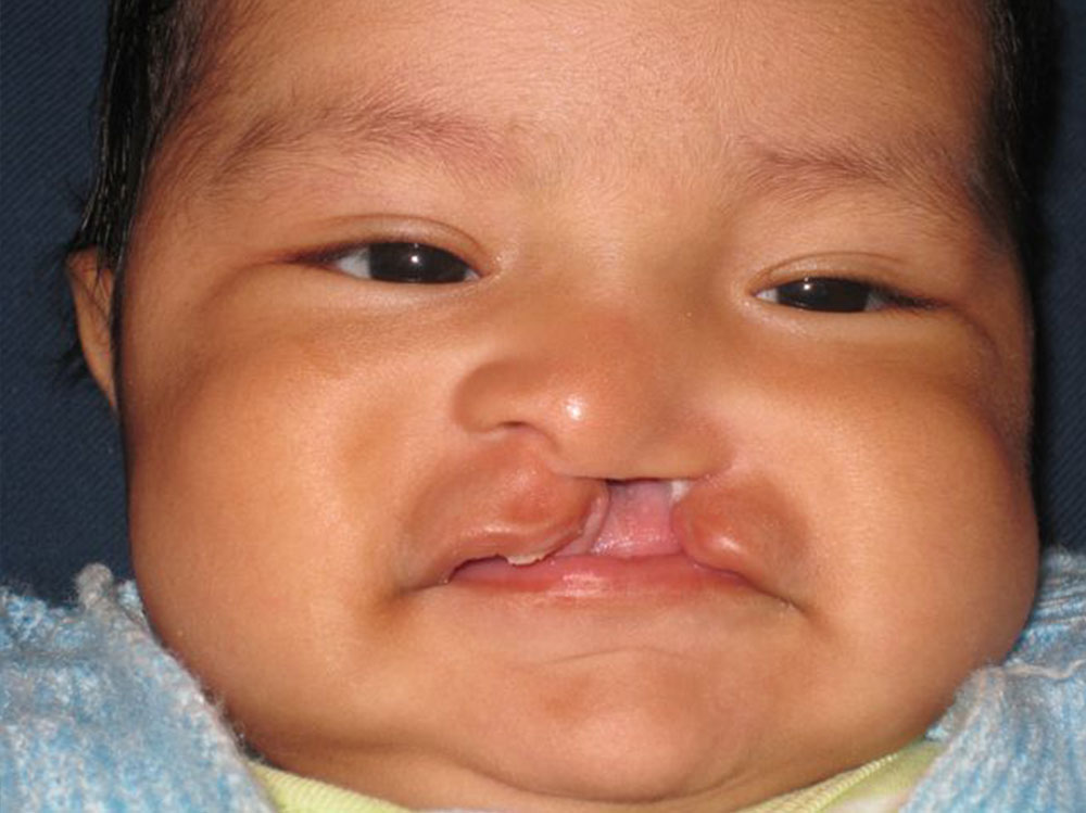 Luis before cleft surgery
