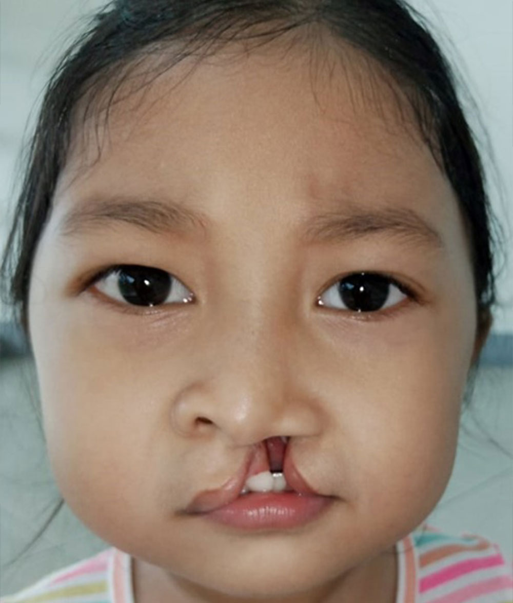 Savannah before cleft surgery