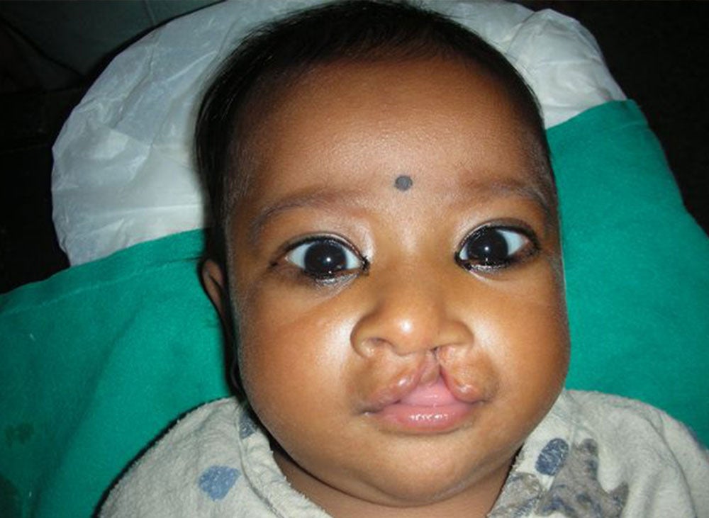 Simrik before cleft surgery