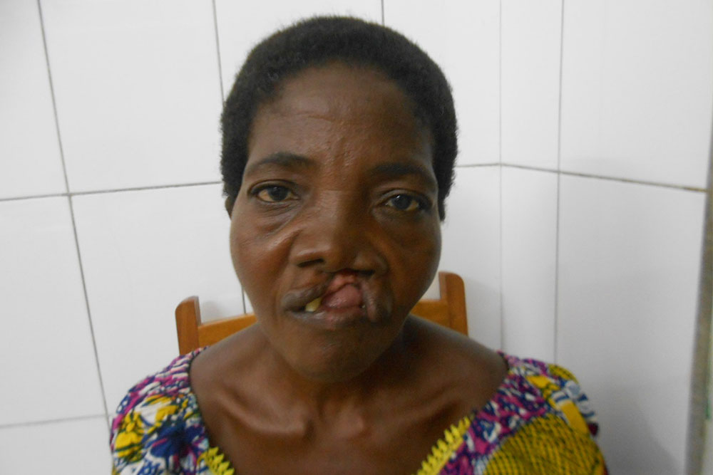 Adjoa before cleft surgery