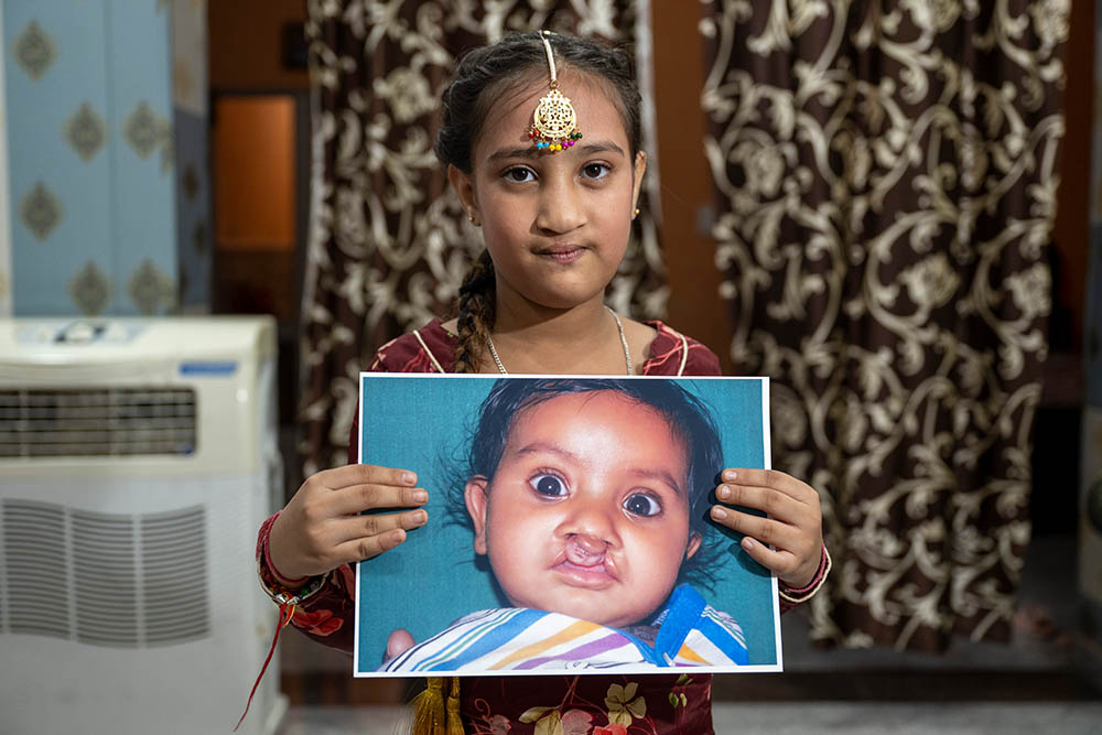 Bhumika smiling and holding a photo of herself before cleft surgery