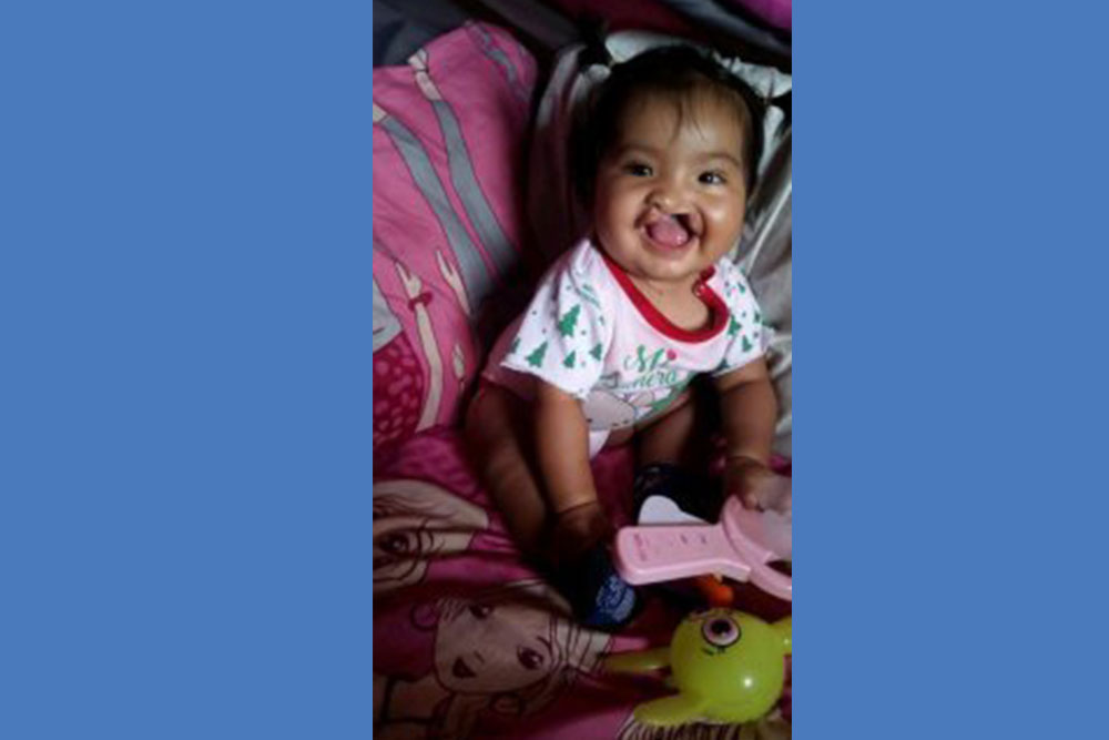 Shaymi loved to smile even before cleft surgery!