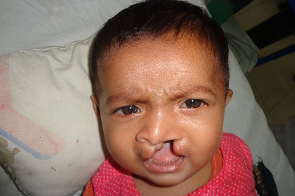 Disha before cleft surgery