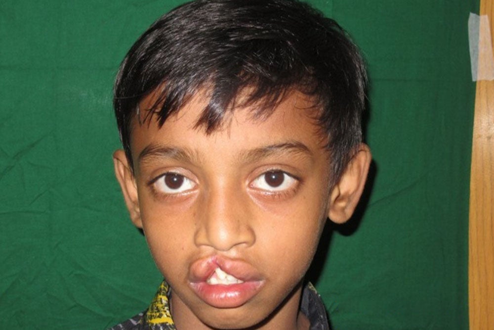Trinoy before cleft surgery