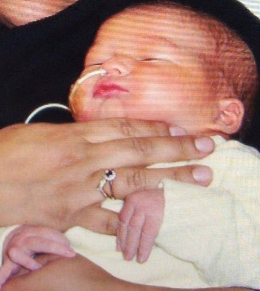 Georgina as a baby with a breathing tube in her nose