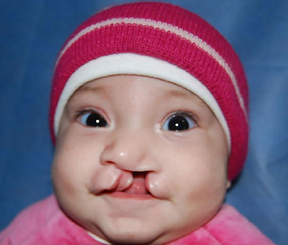 Camila as a baby, before cleft surgery