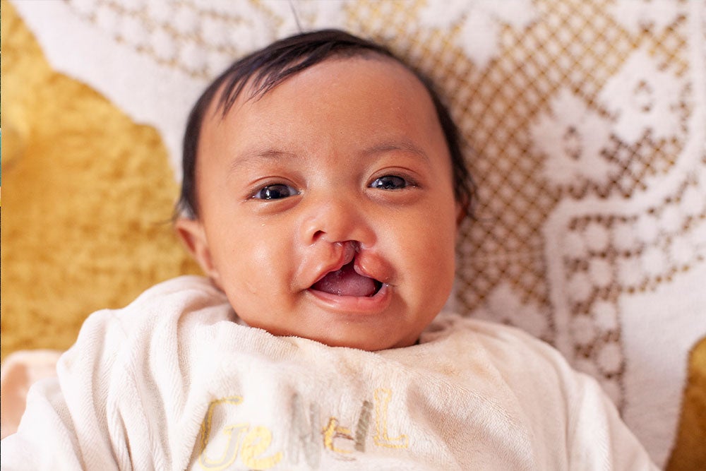 Eden as a baby, before cleft surgery