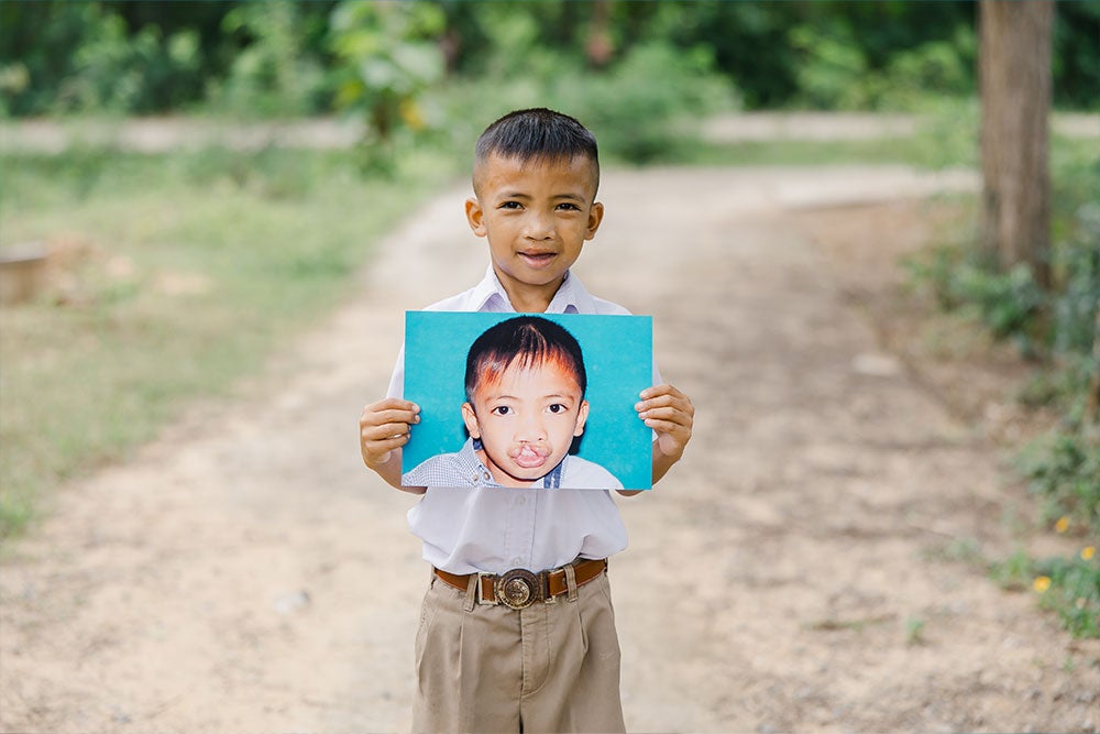 Anuwat today holding a picture of himself before surgery