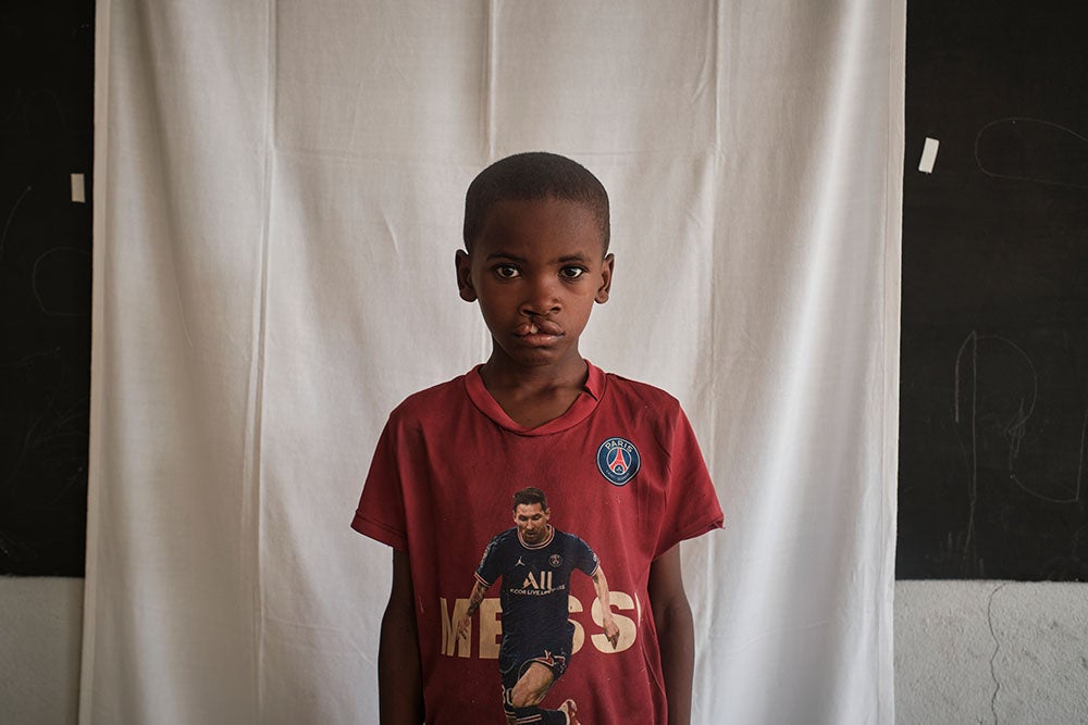 Ferdinand before cleft care Madagascar