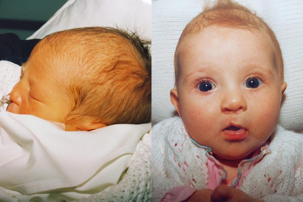 Mimi Middler before and after cleft surgery