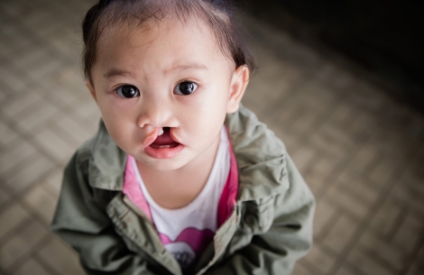 Andrea before cleft surgery