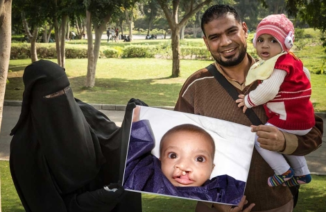 Habeeba's family holds image of her before cleft surgery