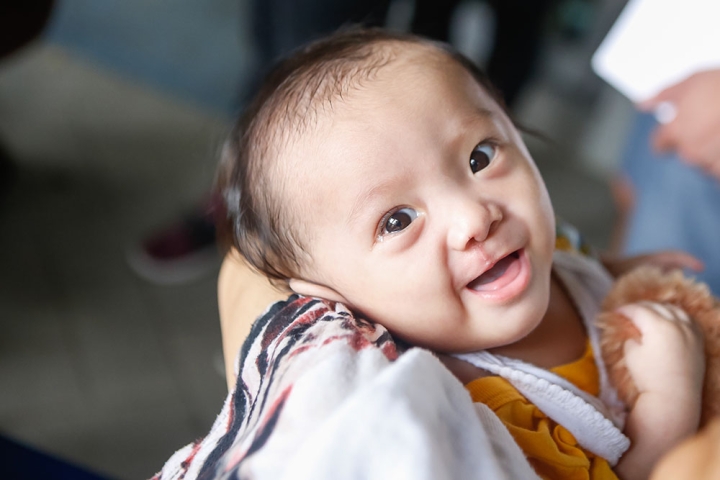 Baby Boy with Cleft Palate