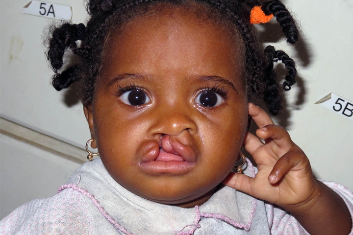 Koko before cleft surgery