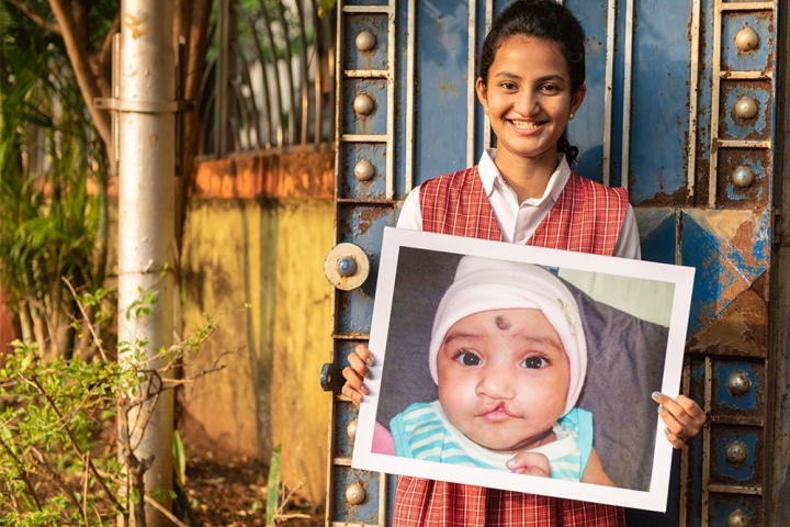 Bhargavi before cleft surgery