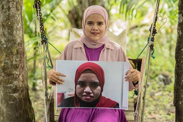 Zuzi holding a picture of herself before cleft surgery