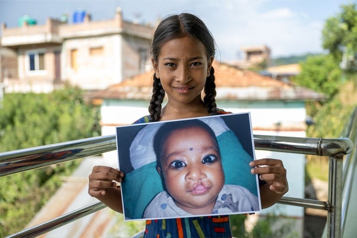 Simrik holding a picture of herself before cleft surgery