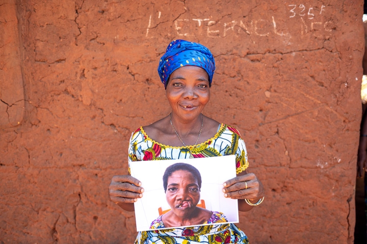 Adjoa smiling and holding a picture of herself before cleft surgery