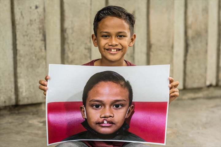 Zafran smiling and holding a photo of himself before cleft surgery