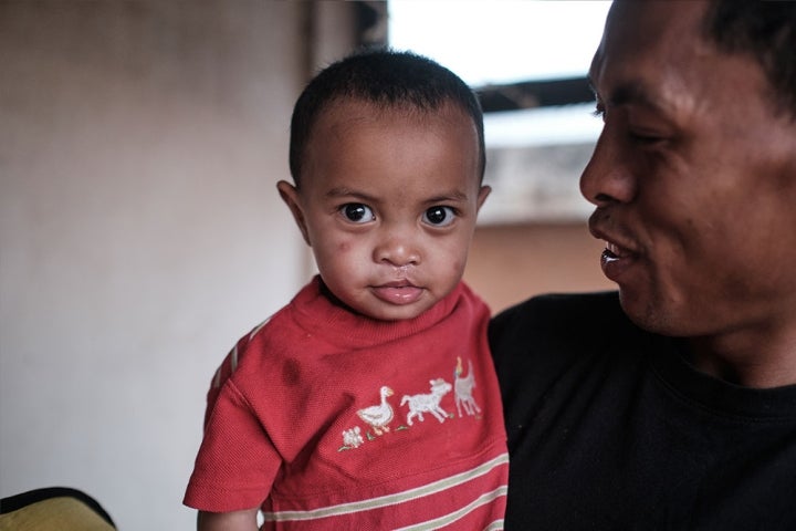 Eden after cleft surgery