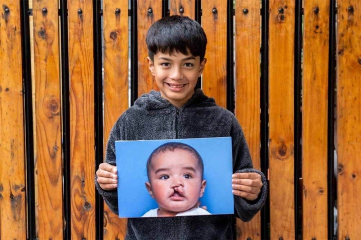 Maximo smiling holding picture before cleft surgery