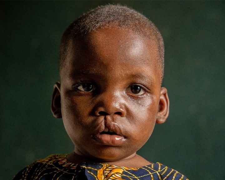 Child in need of cleft lip surgery from Nigeria