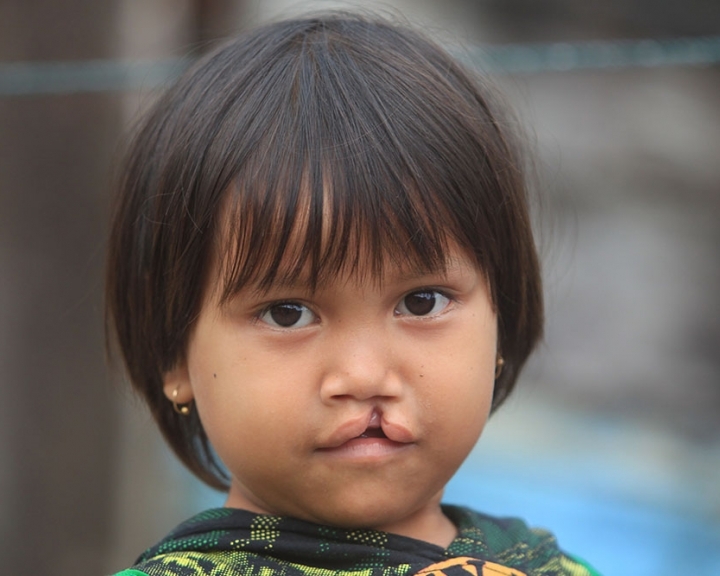 What are the causes of cleft lip and palate?
